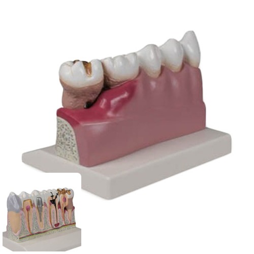 오픈메디칼ZIMMER 치아모형 D250 이빨모형 보건교육