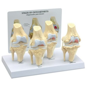 오픈메디칼GPI 무릎관절염모형 G110